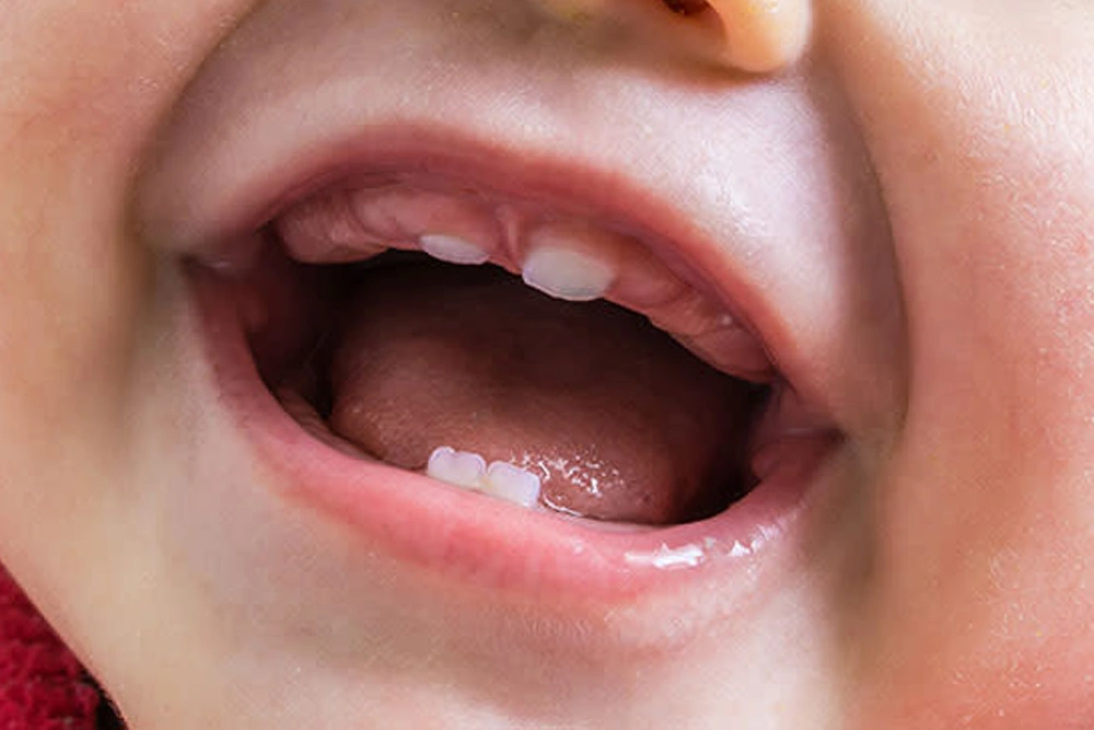 Diagnosing and Treating Lip Ties