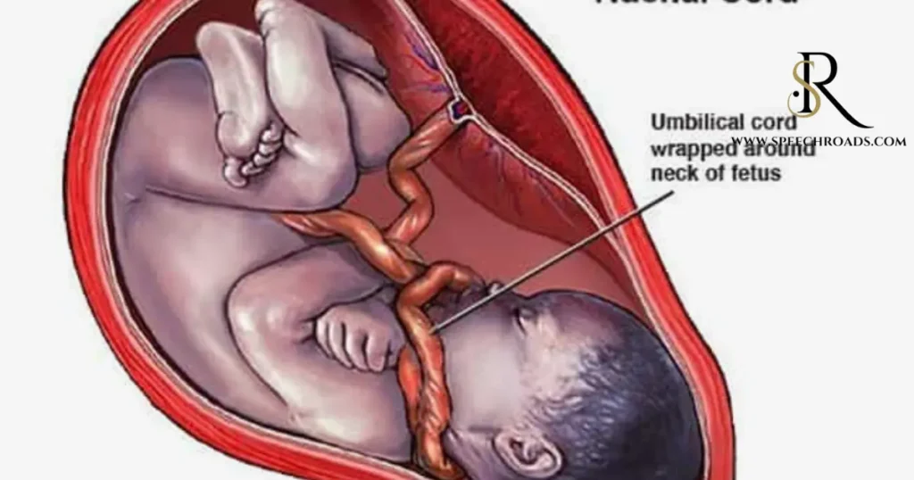 Umbilical Cord Around Neck of Baby Cause Speech Delay